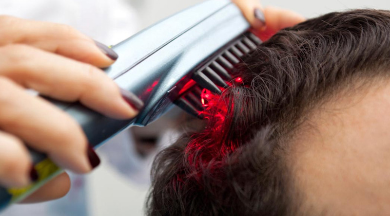 Laser Hair Loss Treatment in Delhi 